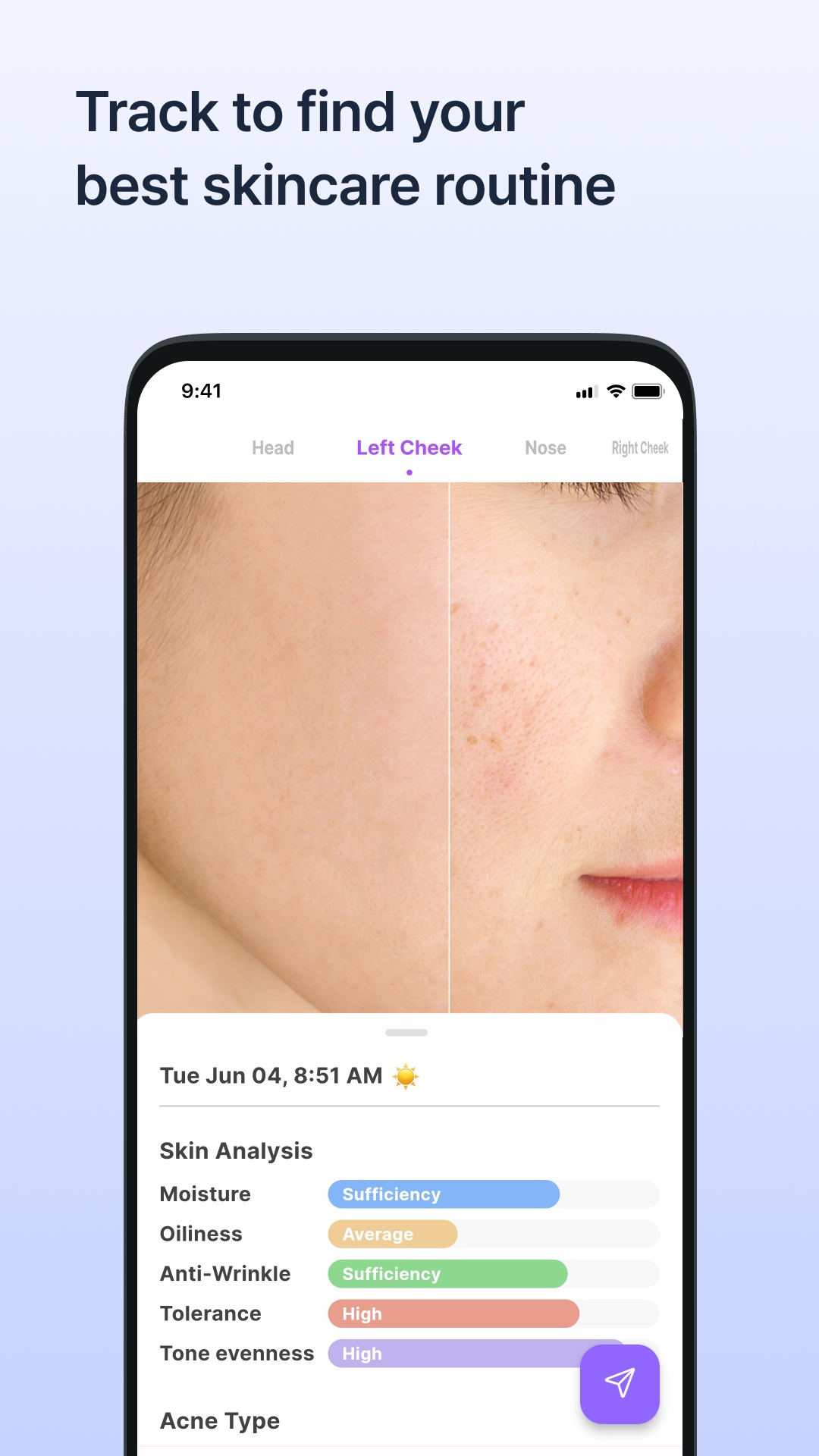SkinLog | Acne diary APK screenshot
